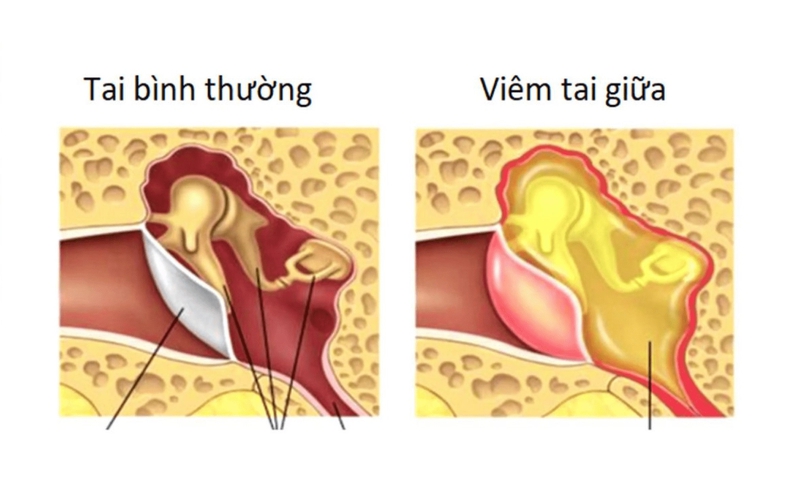 Bé bị viêm tai giữa phải làm sao cho nhanh khỏi 1