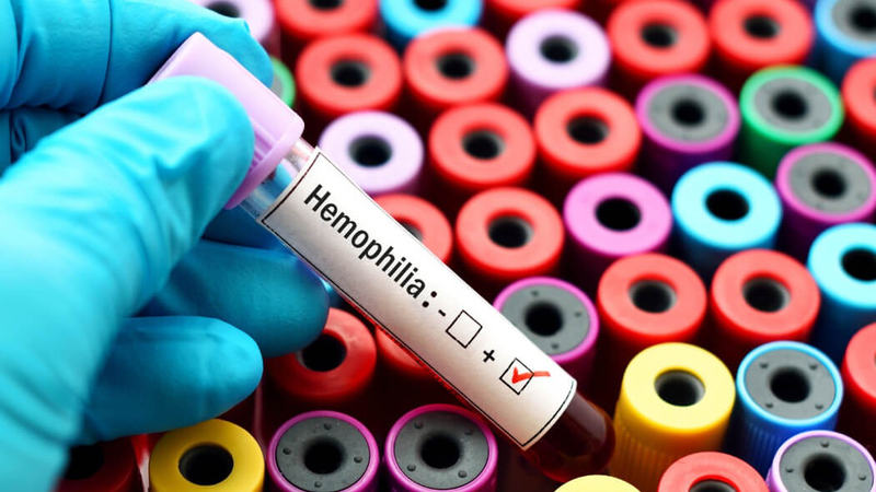 Bệnh Hemophilia (máu khó đông) có nguy hiểm không 1