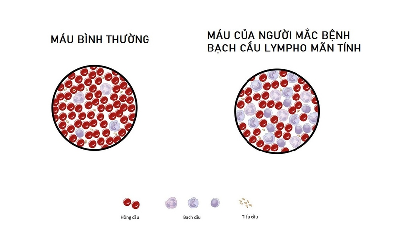 Bệnh bạch cầu lymphocytic mãn tính: Nguyên nhân, triệu chứng, cách điều trị 1