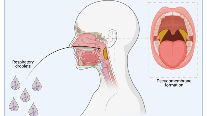 Bệnh bạch hầu lây qua đường nào? Cách phòng tránh lây nhiễm hiệu quả 1