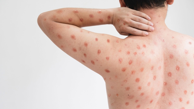 Bệnh đậu mùa khỉ lây qua đường nào? Giải thích chi tiết để chủ động phòng tránh 3