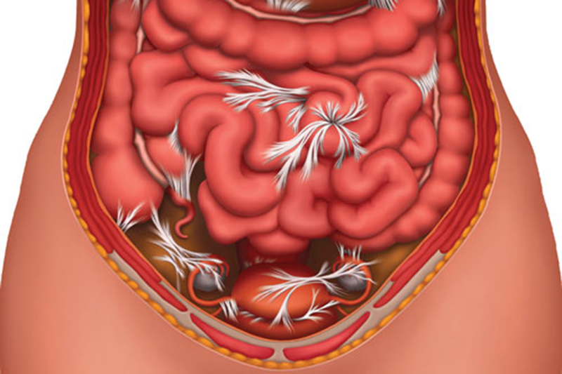 Bệnh dính ruột có nguy hiểm không?1