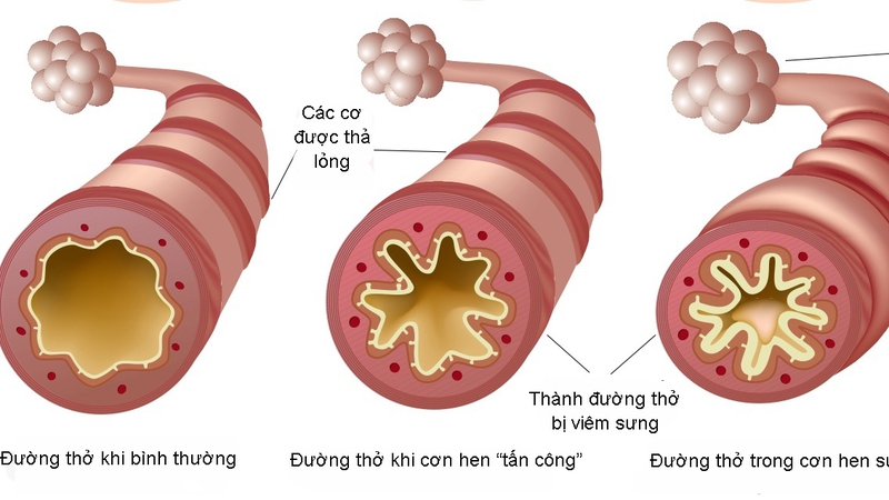 Bệnh hen phế quản nghề nghiệp: Nguyên nhân, triệu chứng và điều trị 2