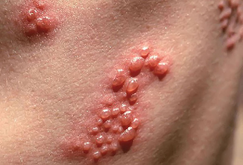 Bệnh herpes có chữa khỏi được không và chữa bằng cách nào 3