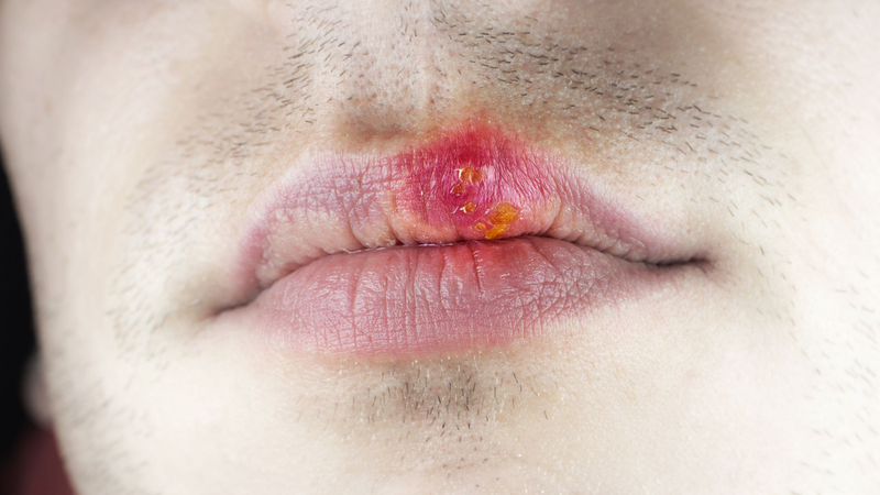 Bệnh herpes môi có nguy hiểm không và điều trị như thế nào? 1