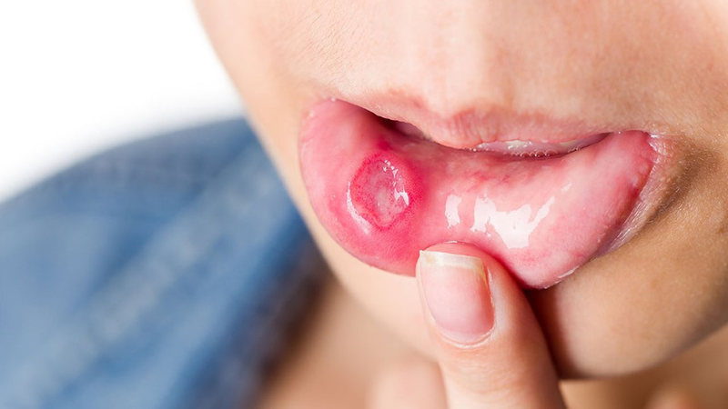 Bệnh lậu ở miệng: Triệu chứng và cách điều trị - Long Châu