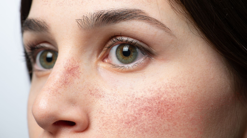 Bệnh Lupus ban đỏ có nguy hiểm không? 1