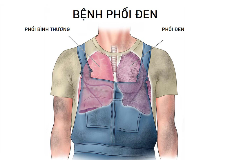 Bệnh phổi đen: Nguyên nhân, triệu chứng, cách điều trị 3