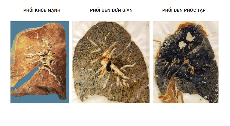 Phổi bị đen là bệnh gì? Nguyên nhân và các vấn đề liên quan