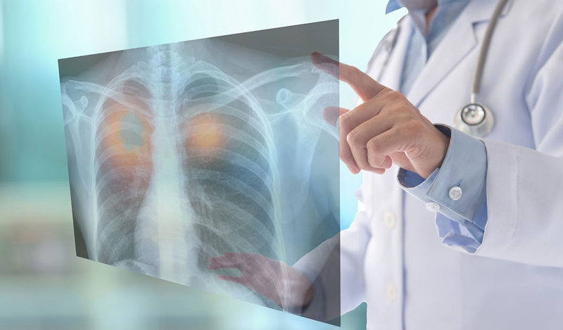 Bệnh phổi mô bào Langerhans là gì? Những vấn đề cần biết về bệnh phổi mô bào Langerhans 4