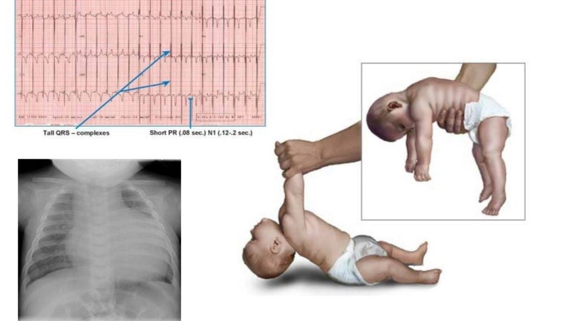 Bệnh Pompe và những điều cần biết 1.jpeg