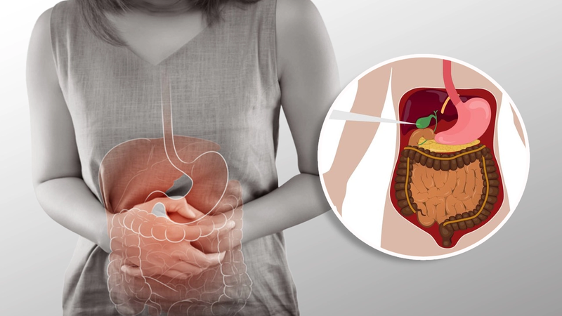 Bệnh sỏi túi mật có nguy hiểm không​?3
