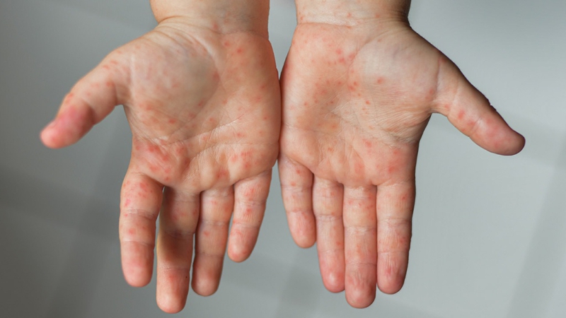 Bệnh tay chân miệng có kiêng gió không? 2