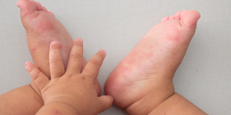 Bệnh tay chân miệng sốt bao nhiêu ngày sẽ khỏi? Cách hạ sốt cho bé bị tay chân miệng 1