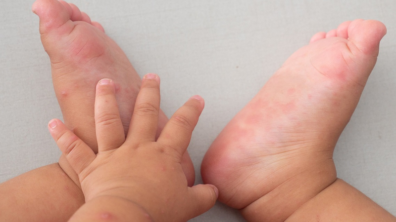 Da nổi mẩn đỏ có mủ ở trẻ em và các bệnh lý trong cơ thể có liên quan 1