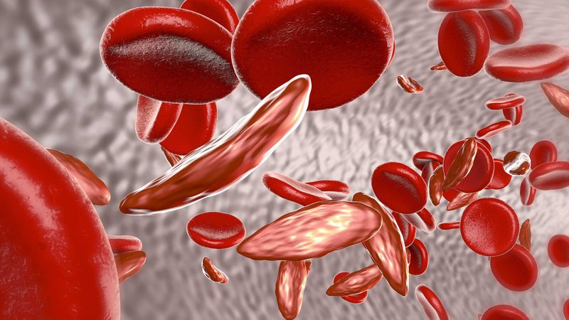 Bệnh thiếu máu hồng cầu nhỏ: Những điều cần biết! 3