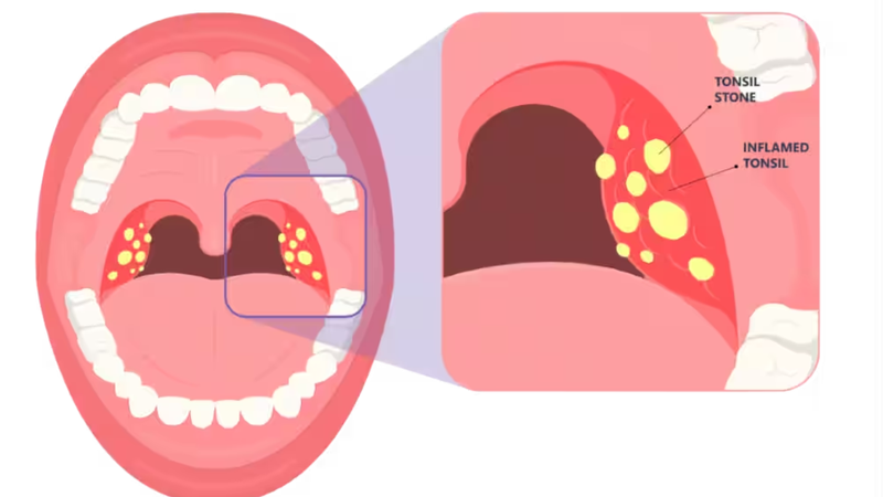 Bệnh tonsil stone là gì? 1