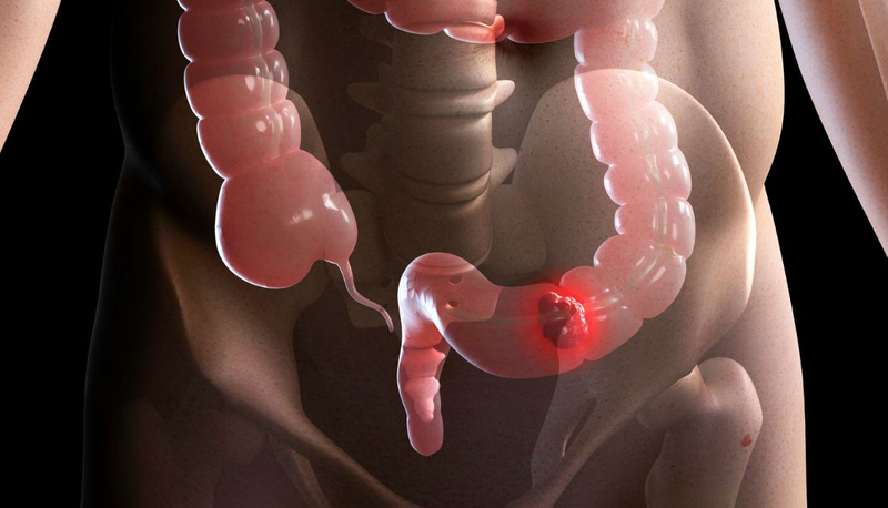 Những bệnh trực tràng​ thường gặp và cách điều trị, phòng ngừa 3