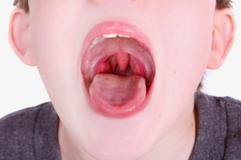 Bệnh viêm VA ở trẻ em có nguy hiểm không? 2