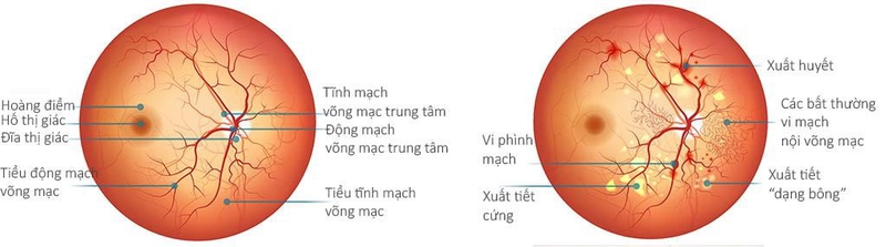 Bệnh võng mạc đái tháo đường: Một căn bệnh thường gặp và âm thầm1