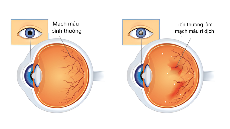 Bệnh võng mạc tiểu đường là những thay đổi ở võng mạc của người bị tiểu đường, có thể dẫn đến giảm thị lực hoặc mù