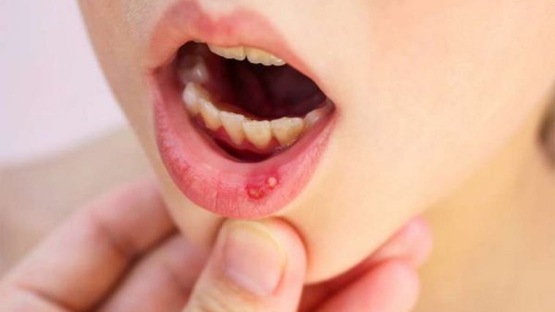 Bị chân tay miệng có ăn được thịt gà không và những điều cần biết 3
