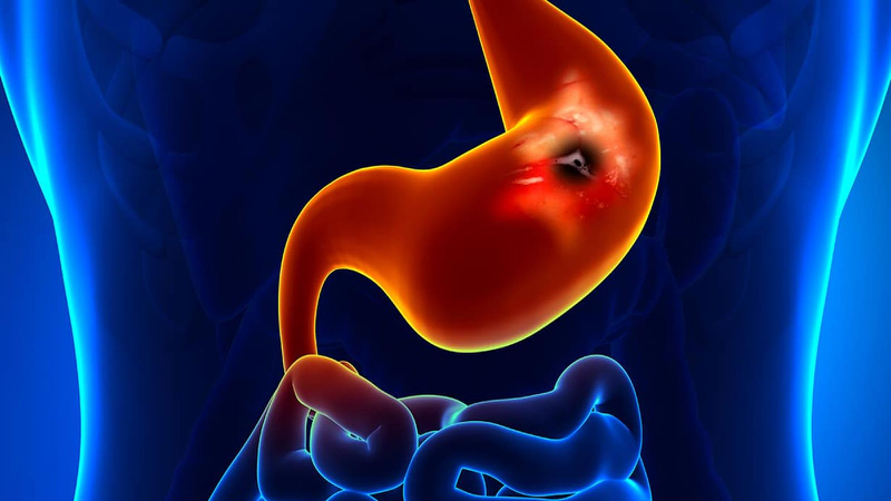 Bị đau bụng trên rốn sau khi ăn: Nguyên nhân và giải pháp 2