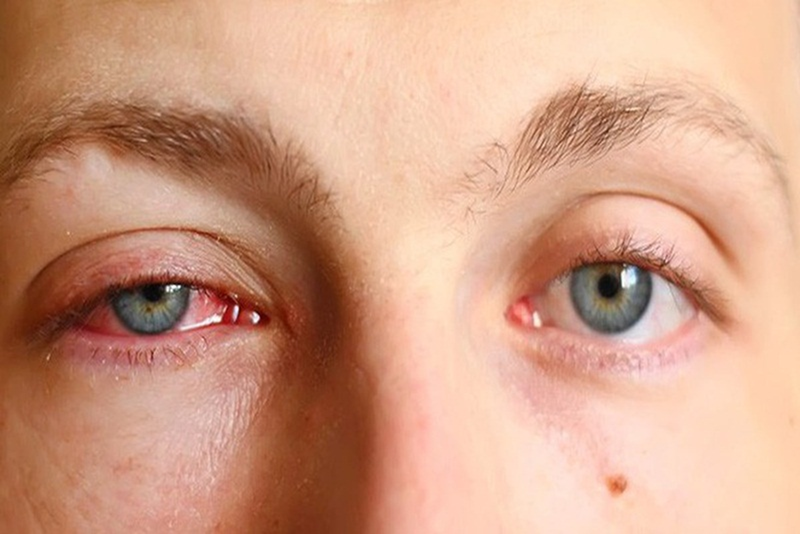 Bị đâu mắt đỏ có sốt không?1