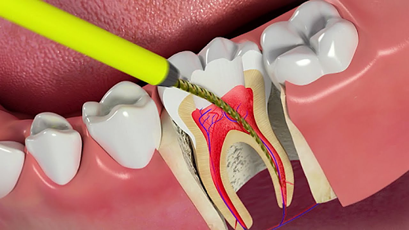  Bị đau răng nổi hạch có nguy hiểm không? 2