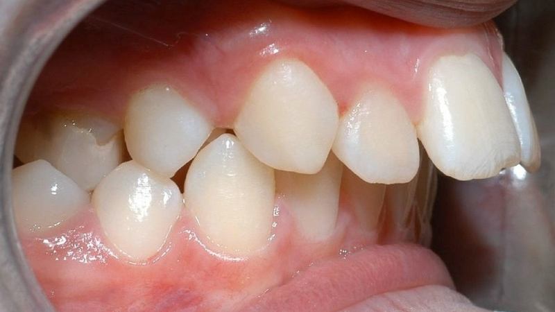 Bị hô hàm có niềng răng được không? Có những phương pháp niềng răng nào?1