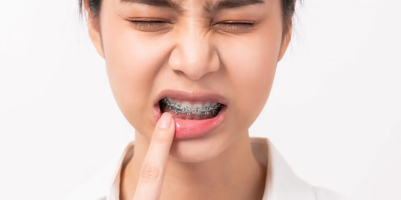 Bị nhiệt miệng khi niềng răng phải làm sao? Cách xử lý hiệu quả 6