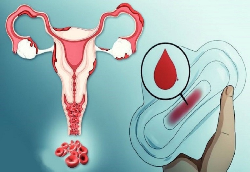 Bị rong kinh có nguy hiểm không? Điều trị rong kinh như thế nào? 2