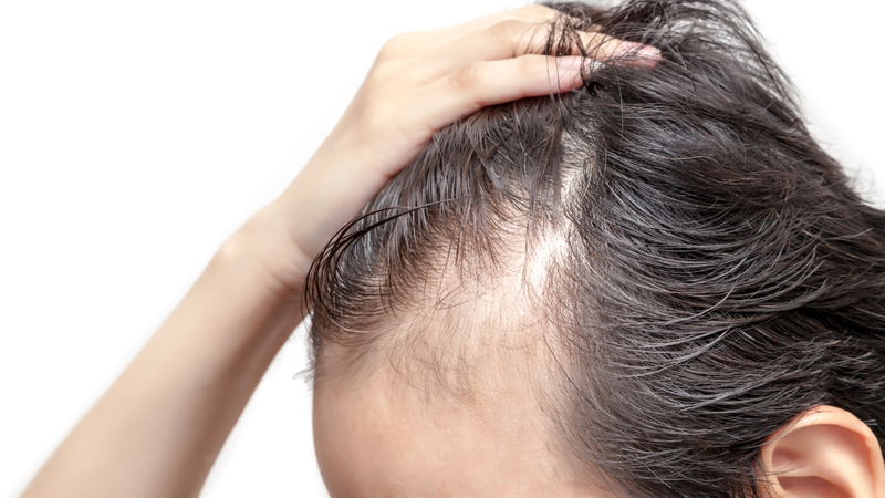 Rụng tóc từng mảng cần được điều trị bằng phương pháp phù hợp