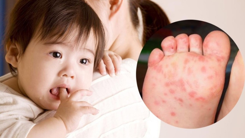 Bị tay chân miệng kèm tiêu chảy: Nguyên nhân, dấu hiệu và cách chăm sóc 1