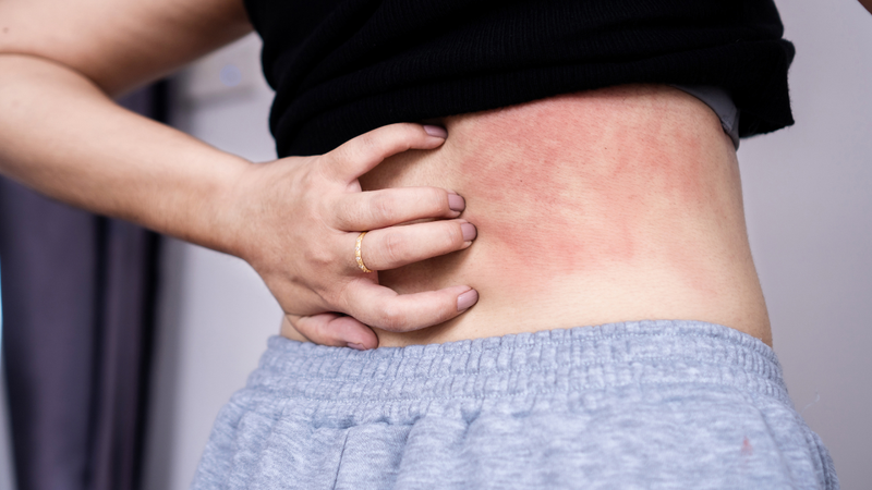 Bị viêm gan B có gây ngứa không? Cách giảm ngứa hiệu quả 1