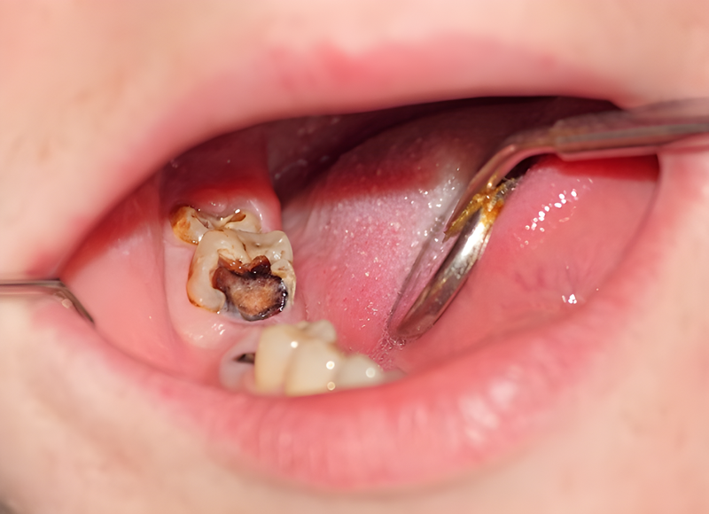 Biểu hiện răng sâu độ 4 là như thế nào?