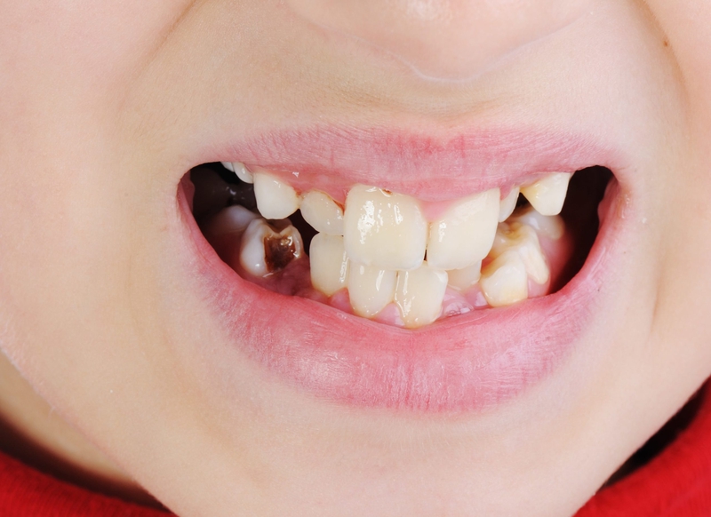 Biểu hiện răng sâu độ 4 là như thế nào? 2