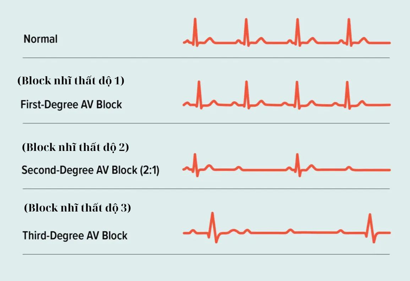 Block nhĩ thất độ 2 có nguy hiểm không 1