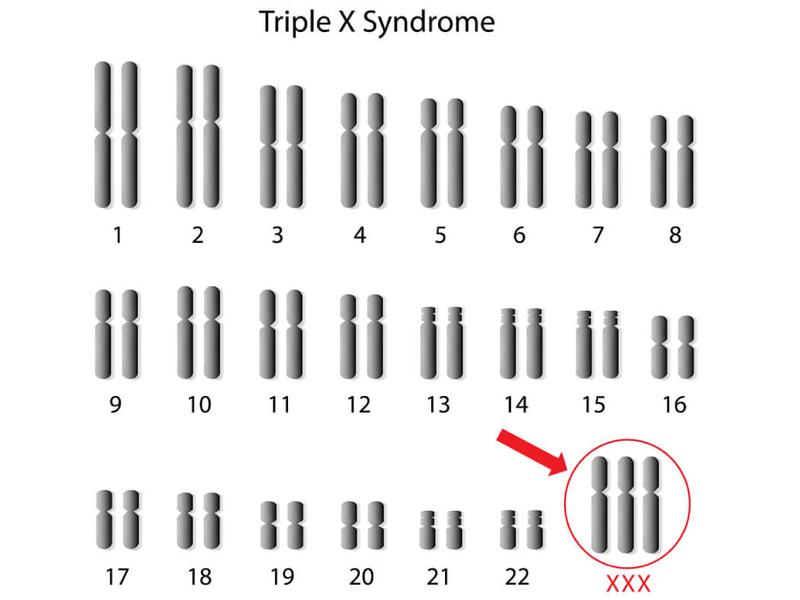 Hội chứng siêu nữ xảy ra do có ba NST giới tính X (XXX)