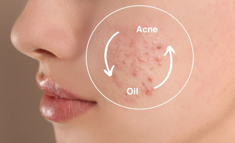 Gợi ý trọn bộ skincare cho da dầu mụn​ 3