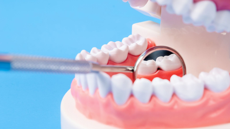 Bọc răng hàm bị sâu giá bao nhiêu​? Quy trình thực hiện 2