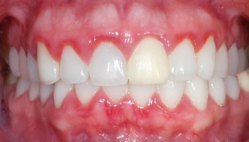 Bọc răng sứ có hại không? Những điều cần lưu ý khi bọc răng sứ 2
