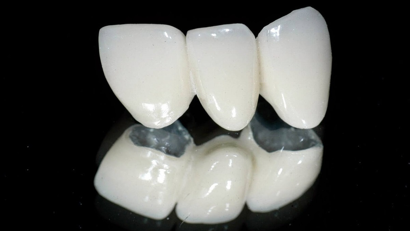 Bọc răng sứ kim loại được bao lâu? 1