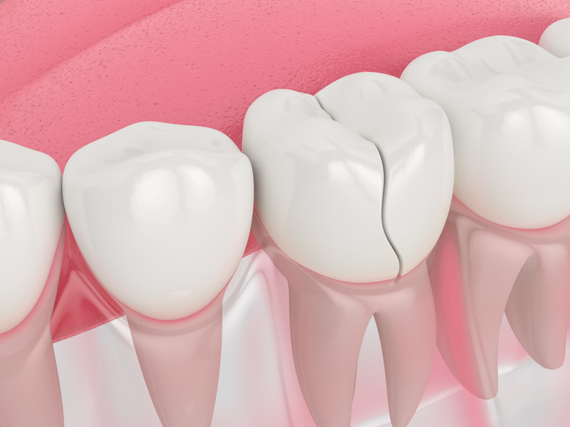 Trong quá trình ăn nhai răng sứ có thể nứt vỡ