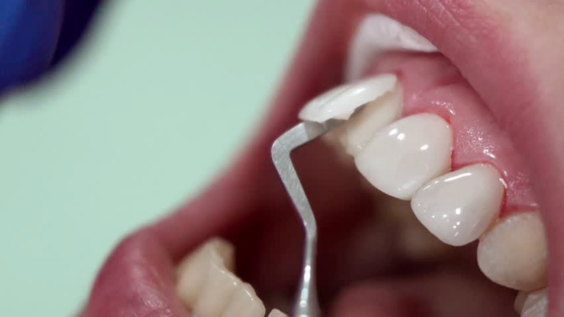 Tùy từng trường hợp, bác sĩ sẽ lựa chọn phương pháp tháo phù hợp
