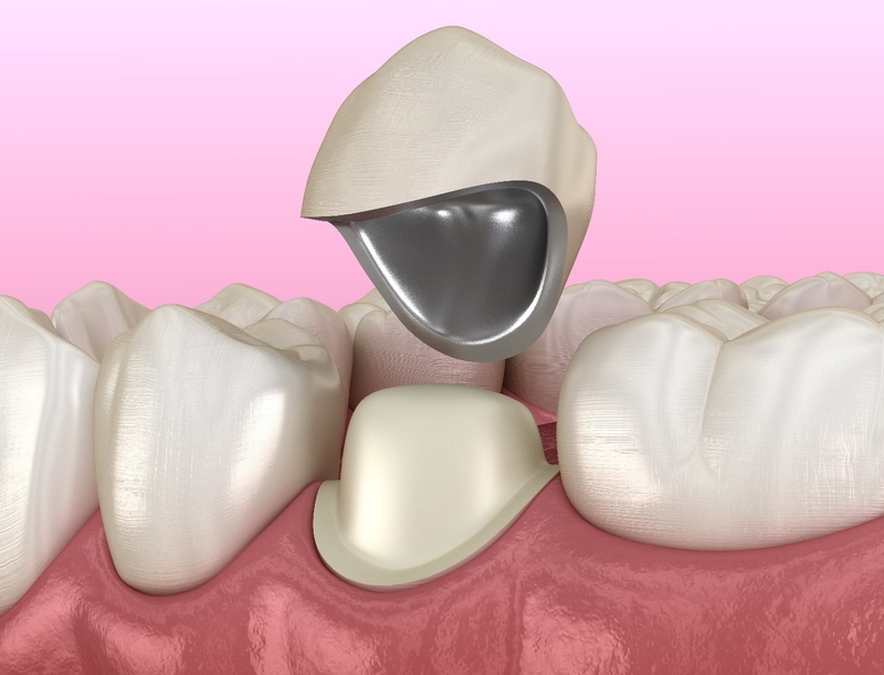 Bọc sứ 16 răng là gì? Chất liệu nào thường được sử dụng để bọc sứ?  2