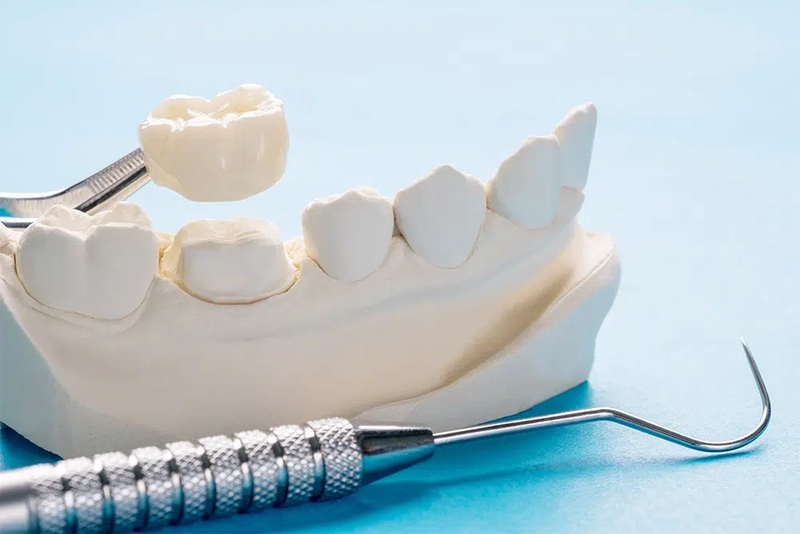 Bọc sứ 16 răng là gì? Chất liệu nào thường được sử dụng để bọc sứ? 3