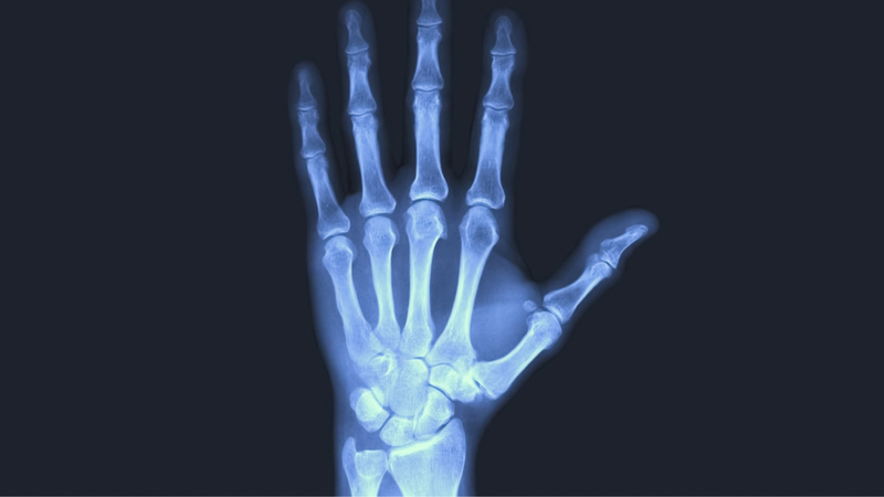 Hình ảnh X-quang giúp bác sĩ xác định mức độ tổn thương và lựa chọn phương án điều trị thích hợp