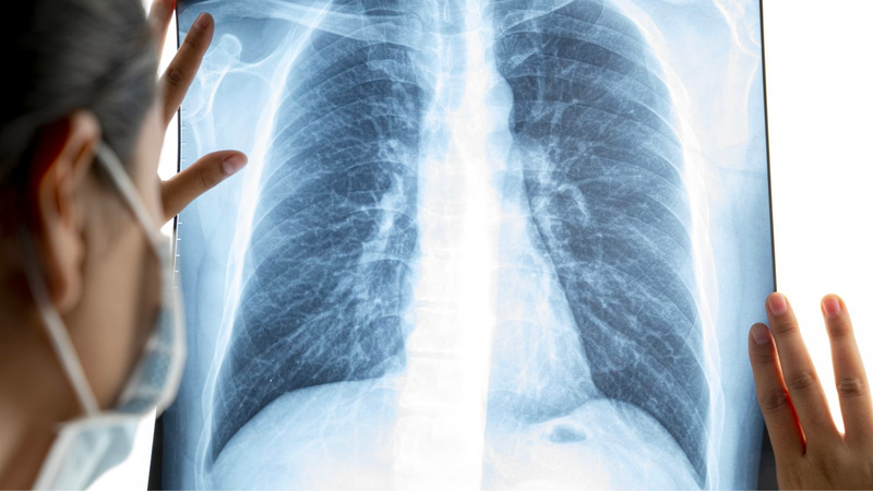 Bệnh bụi phổi là gì? Nguyên nhân, triệu chứng và cách điều trị 6