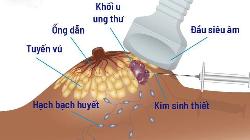 Bướu sợi tuyến vú có nguy hiểm không? 4